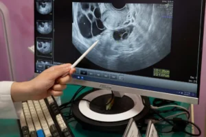 Rethinking Ovarian Cancer: How a Shift in Scientific Understanding is Transforming Prevention