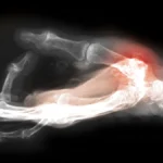 Synovitis as a Driver of Hand Osteoarthritis Progression: A New Understanding Across Joint Sites