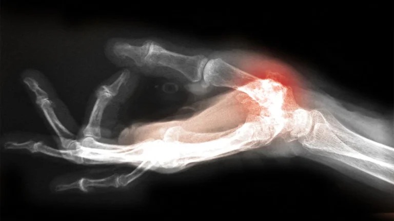 Synovitis as a Driver of Hand Osteoarthritis Progression: A New Understanding Across Joint Sites