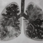 The Carbon Burden: New Research Links Cellular Pollution to COPD Severity
