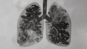 The Carbon Burden: New Research Links Cellular Pollution to COPD Severity