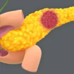The Cumulative Threat: How Pancreatic Cyst Risk Factors Inform Earlier Cancer Detection
