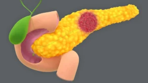 The Cumulative Threat: How Pancreatic Cyst Risk Factors Inform Earlier Cancer Detection
