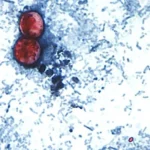 The Invisible Threat: How Sewage Contamination is Fueling a Historic Cyclospora Outbreak