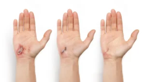 The "Microscope in a Bandage": How AI and Bioelectronics are Revolutionizing Wound Care