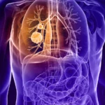 The New Frontier in Precision Oncology: Zipalertinib and the Race to Redefine EGFR Exon 20 Lung Cancer Treatment