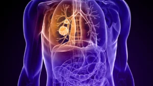 The New Frontier in Precision Oncology: Zipalertinib and the Race to Redefine EGFR Exon 20 Lung Cancer Treatment