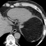 The Numbers vs. The Image: Refining the Future of Cardiovascular Risk Assessment