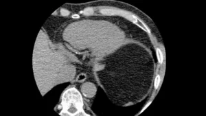 The Numbers vs. The Image: Refining the Future of Cardiovascular Risk Assessment