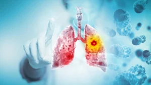 The Paradox of Prevention: New Research Investigates Link Between Healthy Diets and Lung Cancer in Young Non-Smokers