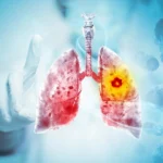 The Paradox of Prevention: New Research Investigates Link Between Healthy Diets and Lung Cancer in Younger Non-Smokers
