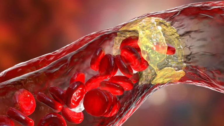 The Silent Accumulation: New Study Links Microplastics to Accelerated Heart Disease