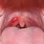 The Silent Crisis: How Alcohol and Tobacco Are Driving an Epidemic of Mouth Cancer in India