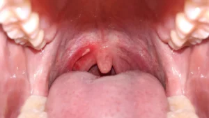 The Silent Crisis: How Alcohol and Tobacco Are Driving an Epidemic of Mouth Cancer in India