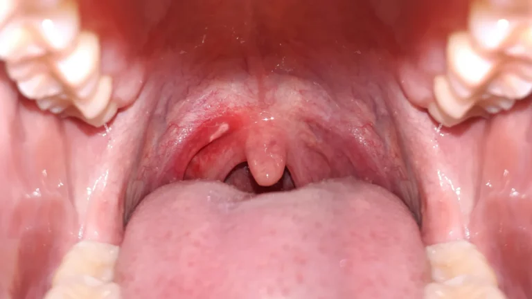The Silent Crisis: How Alcohol and Tobacco Are Driving an Epidemic of Mouth Cancer in India
