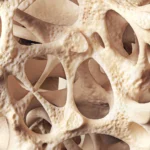 The Silent Epidemic: Understanding and Managing Osteopenia for Lifelong Bone Health