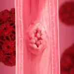 The Viral Enigma: Investigating the Controversial Link Between HPV and Esophageal Cancer