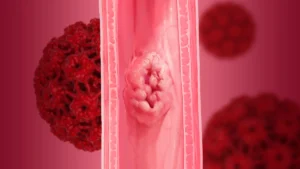 The Viral Enigma: Investigating the Controversial Link Between HPV and Esophageal Cancer
