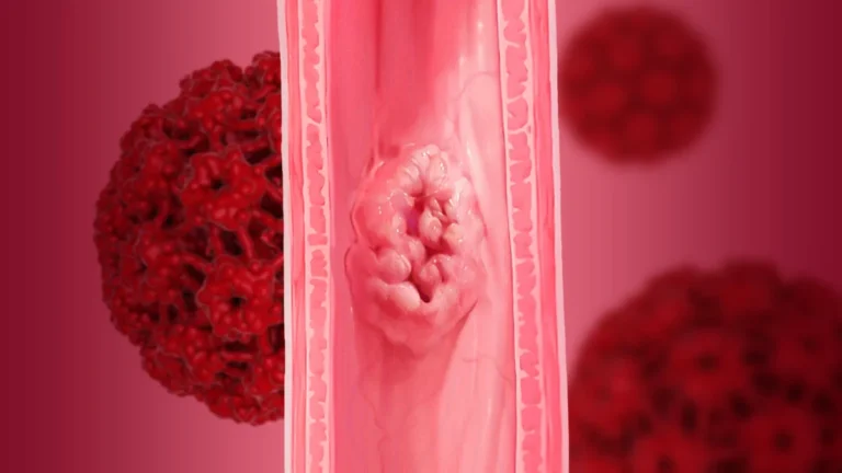 The Viral Enigma: Investigating the Controversial Link Between HPV and Esophageal Cancer