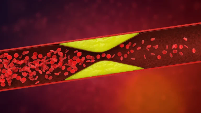 Unlocking the Genetic Code of Venous Thrombosis: New Research Illuminates Hidden Risks