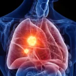 A Breakthrough in the Shadows: Novel Strategy Offers New Hope for Mesothelioma Patients