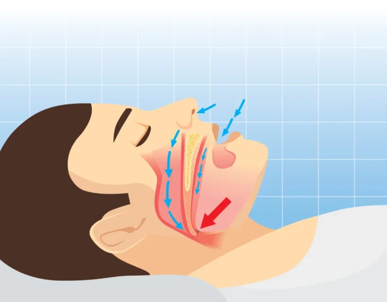 A New Frontier in Sleep Medicine: Mosanna Therapeutics Advances Novel Nasal Spray for Obstructive Sleep Apnea