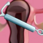 Addressing the IUD Pain Gap: New Clinical Evidence for Intrauterine Mepivacaine