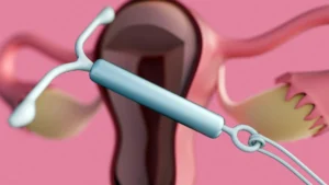 Addressing the IUD Pain Gap: New Clinical Evidence for Intrauterine Mepivacaine