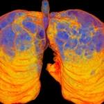 AstraZeneca’s Tozorakimab Marks a Watershed Moment in the Fight Against COPD