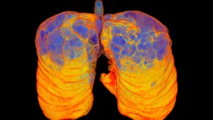 AstraZeneca’s Tozorakimab Marks a Watershed Moment in the Fight Against COPD