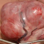 Beyond the Hysterectomy: Comparing Two Leading Uterine-Sparing Treatments for Fibroids