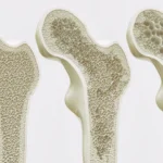 Beyond the Morning Brew: New Study Explores the Long-Term Impact of Coffee and Tea on Bone Health in Aging Women