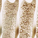 Breakthrough in Bone Health: Leipzig Researchers Uncover Novel Receptor Target for Osteoporosis