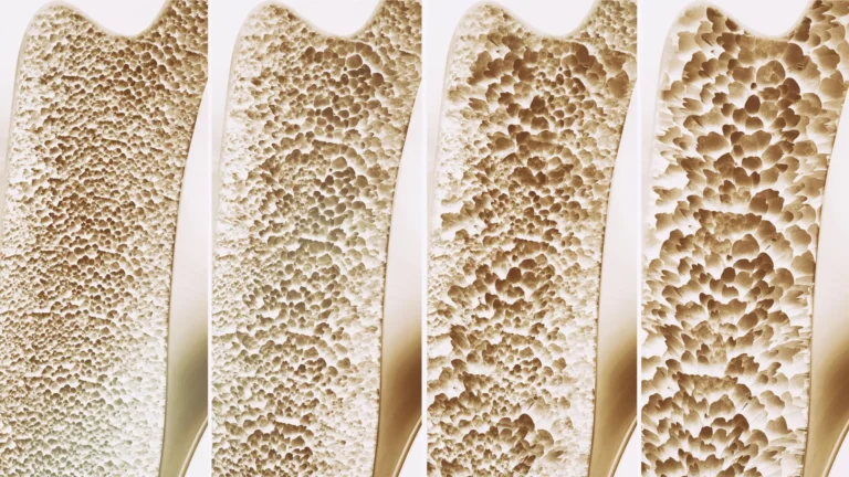 Breakthrough in Bone Health: Leipzig Researchers Uncover Novel Receptor Target for Osteoporosis