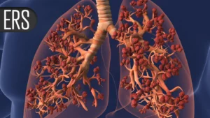 Breakthrough in COPD Treatment: Tozorakimab Shows Promise in Phase III Trials