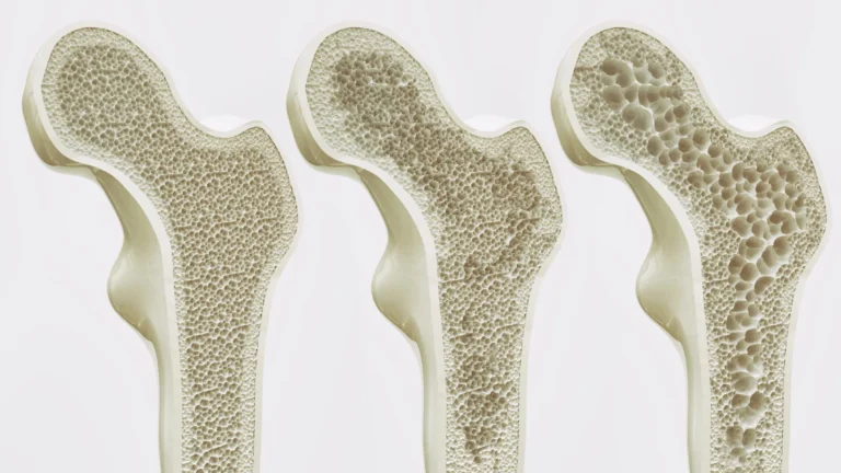 Brewing Better Bone Health: New Flinders University Study Reveals the Complex Impact of Tea and Coffee on Aging Women