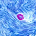 Celldex’s Barzolvolimab Shows Unparalleled Efficacy in Chronic Hives, Despite Anaphylaxis Safety Concerns