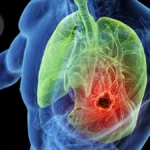 Clinical Setback: Local Consolidative Therapy Fails to Enhance Outcomes in Metastatic NSCLC Patients