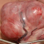 Comparing Outcomes: Laparoscopic Radiofrequency Ablation vs. Myomectomy for Uterine Fibroids