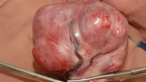 Comparing Outcomes: Laparoscopic Radiofrequency Ablation vs. Myomectomy for Uterine Fibroids
