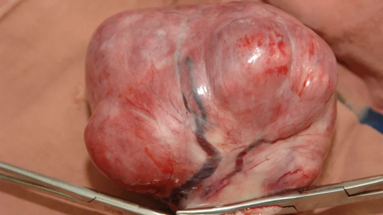 Comparing Outcomes: Laparoscopic Radiofrequency Ablation vs. Myomectomy for Uterine Fibroids