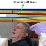 Decoding the Night: New 3D Simulations Unmask the Mechanics of Snoring