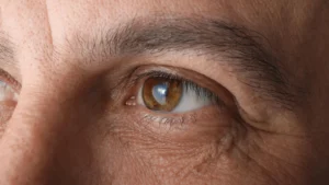 Long-Term Tadalafil Use Linked to Increased Glaucoma Risk: A Comprehensive Analysis