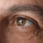 Long-Term Tadalafil Use Linked to Increased Glaucoma Risk: A Deep Dive into New Findings