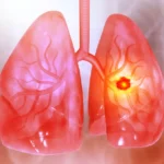 Lung Cancer Breakthroughs: How New Data from WCLC Is Reshaping Oncology