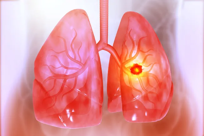 Lung Cancer Breakthroughs: How New Data from WCLC Is Reshaping Oncology