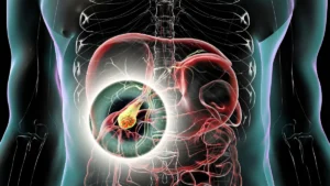 New Safety Signal: GLP-1 Receptor Agonists Linked to Gallbladder Risks in Adolescents