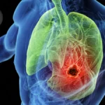Rethinking the Standard of Care: MAVERICK Trial Challenges PCI in Small Cell Lung Cancer