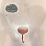 The Future of Continence: How Remote-Controlled Technology is Transforming Post-Prostatectomy Recovery