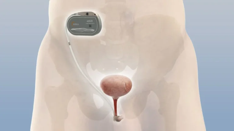 The Future of Continence: How Remote-Controlled Technology is Transforming Post-Prostatectomy Recovery